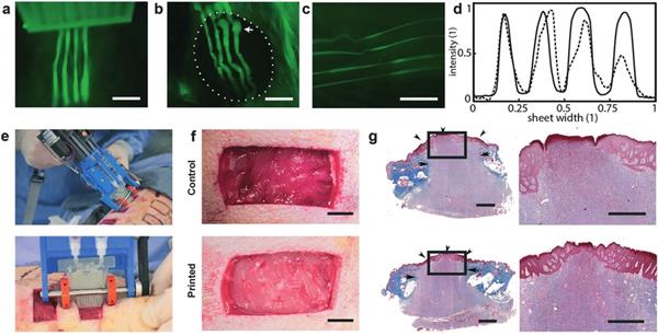 多伦多大学开发手持式皮肤 3D 打印机，用于快速修复深度伤口