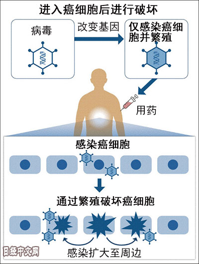 日本研发病毒抗癌疗法 治疗胰腺癌具有效果