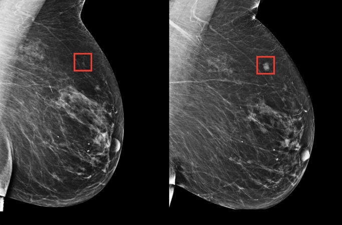 深度学习9万张乳房X光照后 AI模型可预测未来5年是否恶化为乳腺癌