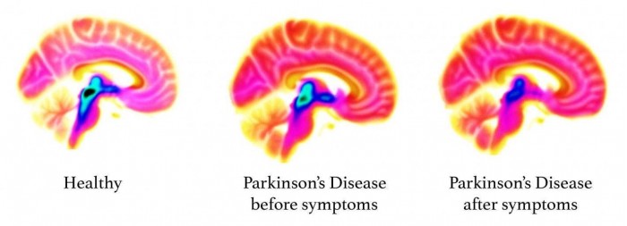大脑血清素或成为早几十年发现帕金森患病迹象的新生物标志物