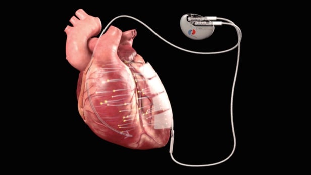 科学家研发实验性新植入物 用微电流电脉冲来治疗心肌病
