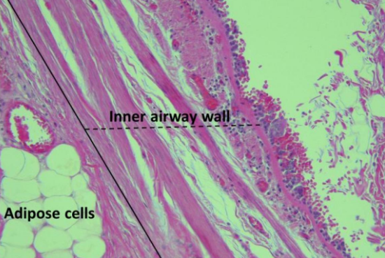 科学家首次在肥胖者气道中发现脂肪堆积