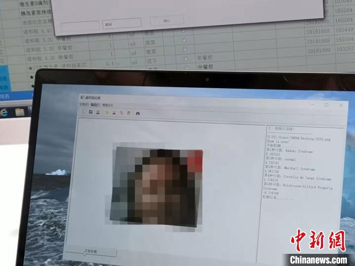 专家打造中国人“遗传病面部筛查系统”
