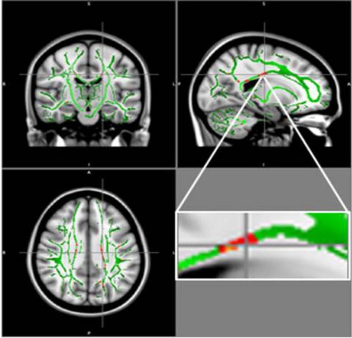 巴西科学家进行的MRI研究揭示了青少年肥胖与脑损伤之间的联系