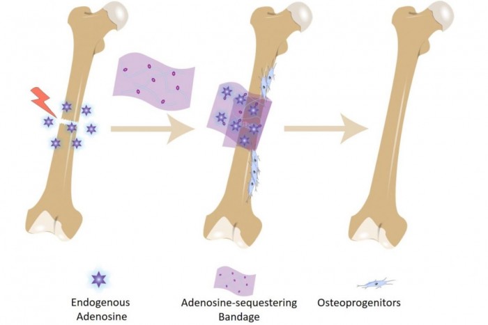 科学家研发新型绷带 通过捕获生化物质治愈骨折的骨头