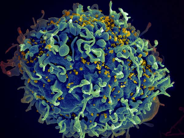 南非科研团队宣布在艾滋病预防方面取得突破性进展