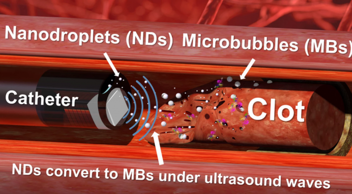 科学家展示超声“钻头” 利用纳米液滴破除顽固血凝块